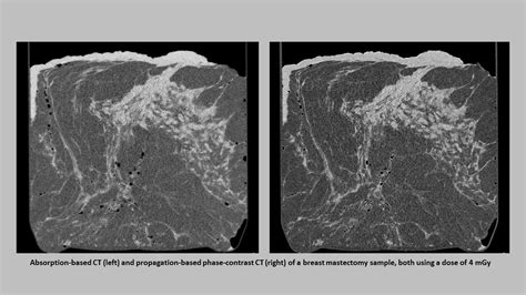 Phase-Contrast Imaging For Breast Cancer Diagnosis | Syntec Optics