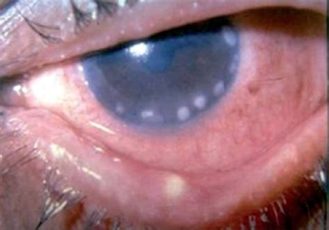 Keratitis - Causes, Symptoms, Diagnosis, Prevention, Treatment