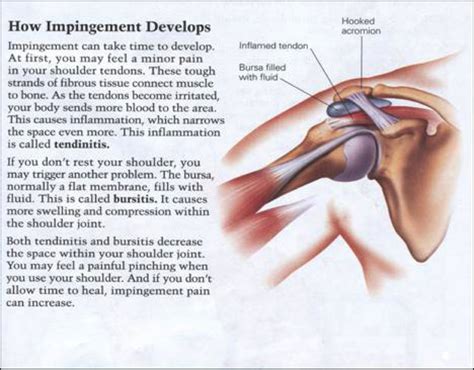 SUBACROMIAL SHOULDER IMPINGEMENT SYNDROME