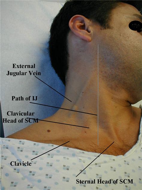 The Jugular Venous Pulse And Hepatojugular Reflux Examinations Of ...