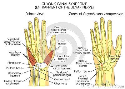 Entrapment Of The Ulnar Nerve In The Wrist In The Guyon’s Cana Stock ...