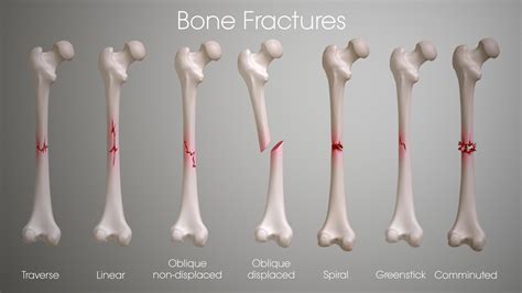 Thanks I hate bone fractures, : r/TIHI