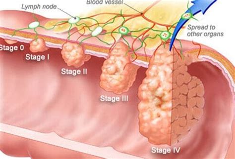 Colon Cancer