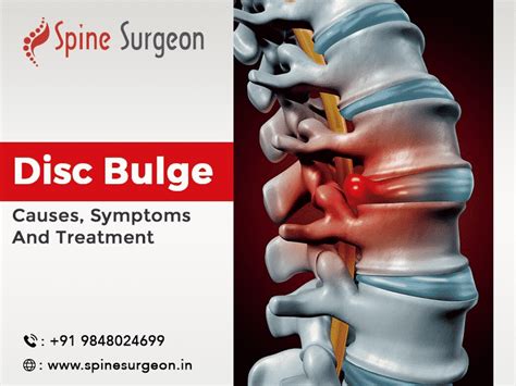 Disk Bulge causes, symptoms and treatment | Spine Surgeon