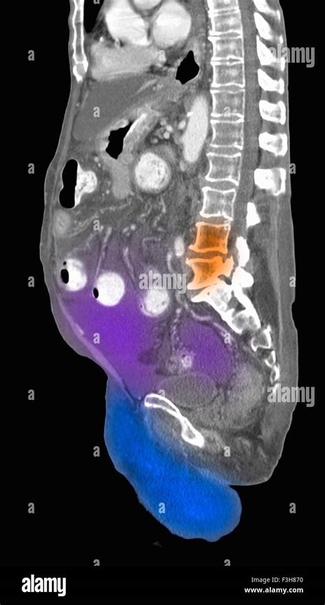 CT scan contrast abdomen pelvis Stock Photo - Alamy