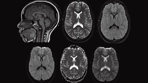 Stroke vs Normal Brain MRI Mri shows 'brain scars' in military ...