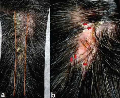 Tufted hair folliculitis with linear arrangement - Indian Journal of ...