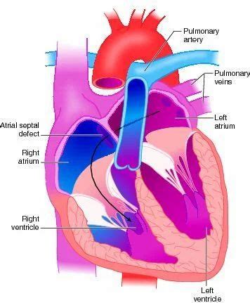 Congenital Heart Defect Corrective Surgery in Mumbai | ID: 13365563297