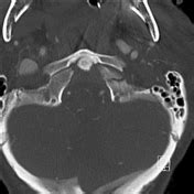 Occipital Condyle Fracture Treatment