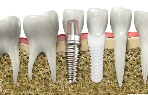 Titanium or Ceramic Implants: Does It Make a Difference Which You ...