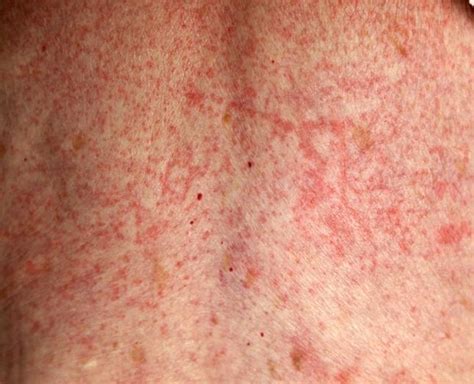 drug allergy rashes pictures - pictures, photos