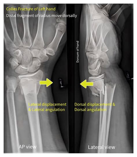 Colles Fracture - Emedicodiary