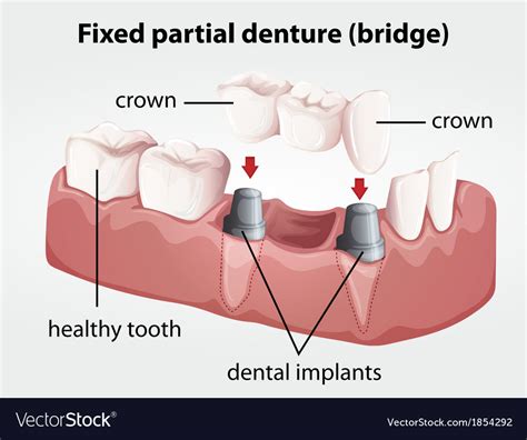 Fixed partial denture bridge Royalty Free Vector Image