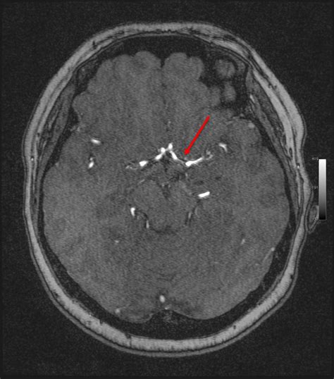 Young stroke with MCA stenosis – Radiology Cases