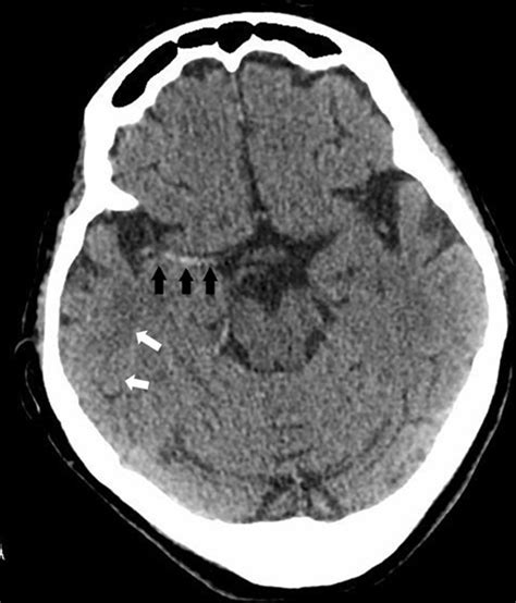 A case of large right MCA stroke with hyperdense MCA sign in CT imaging ...