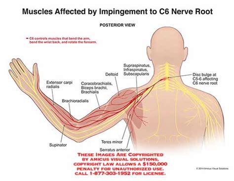 Muscles Affected by Impingement to C6 Nerve Root