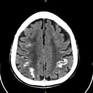 Head CT scan showing diffuse brain atrophy with cortical calcifications ...