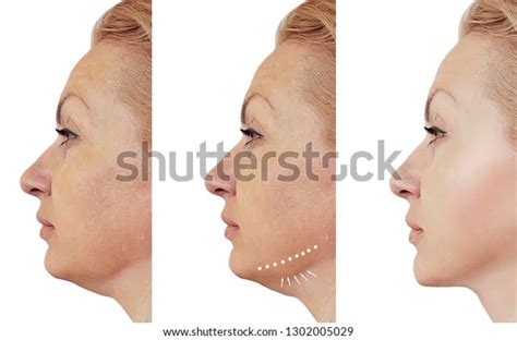 Woman Double Chin Before After Procedures Stock Photo (Edit Now) 1302005029