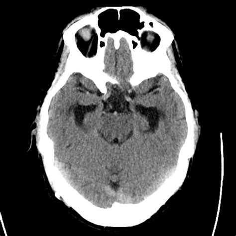 Differential Diagnosis of CSF Shunt Complications