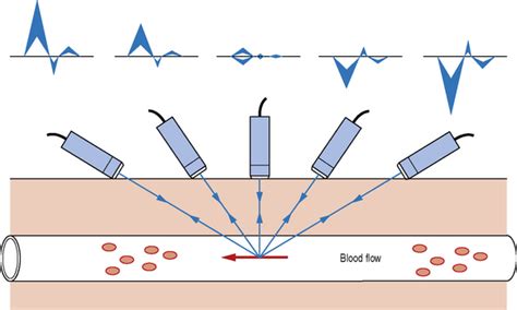 Speed and Direction of Blood flow - Doppler Ultrasound - SONOSIF - by ...