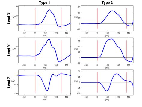 P wave morphology Type 1 and 2. The two principal orthogonal P wave ...