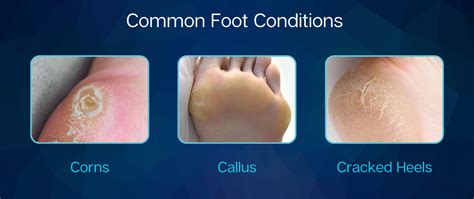 What Causes A Corn On Bottom Of Foot Online | emergencydentistry.com