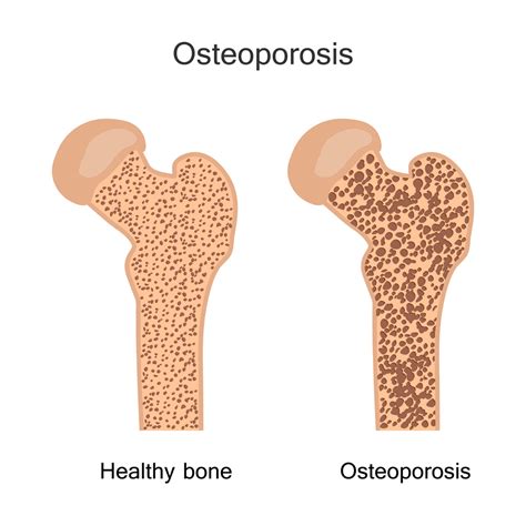 Osteoporosis Screening - University Diagnostic Medical Imaging