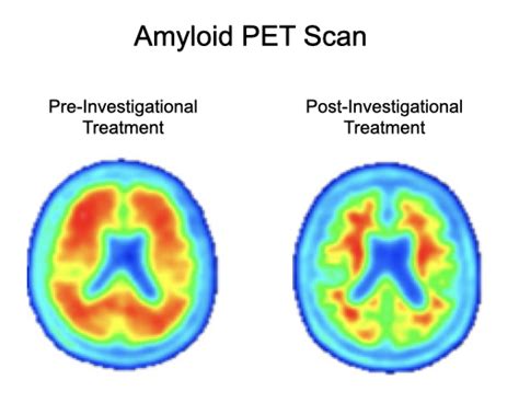 Participate in the Alzheimer's Disease Clinical Trial | The AHEAD Study