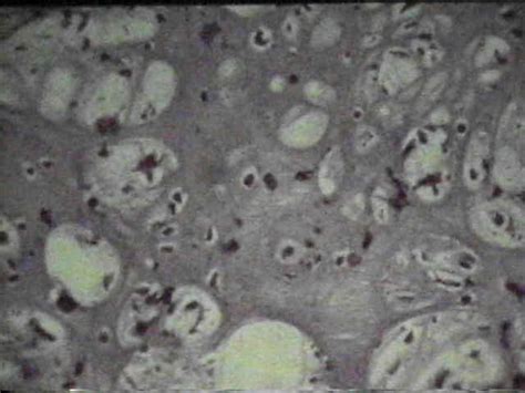 Histology of Chondrosarcoma : Wheeless' Textbook of Orthopaedics