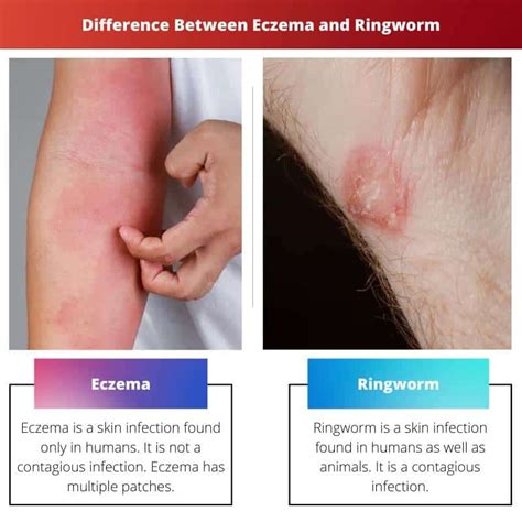 Eczema vs Ringworm: Difference and Comparison