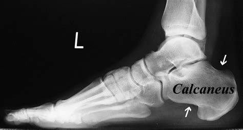 life after a calcaneus fracture surgery - Yasuko Woodcock