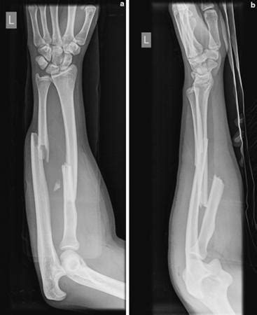 The Compound Fracture Of Radius