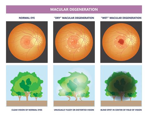 Dry Macular Degeneration