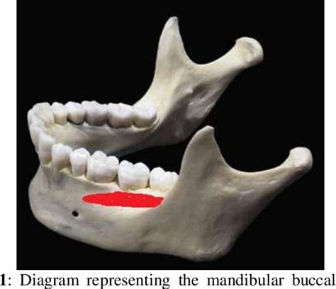 Figure 1 from Mandibular buccal shelf and infra zygomatic crest – A ...