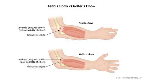 Tennis Elbow (Lateral Epicondylitis) - Causes, Symptoms & Signs ...