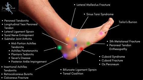 Foot Pain Diagnosis Chart Gallery Of Chart | SexiezPicz Web Porn