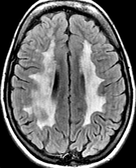 Adult Leukodystrophies: A Step-by-Step Diagnostic Approach | RadioGraphics