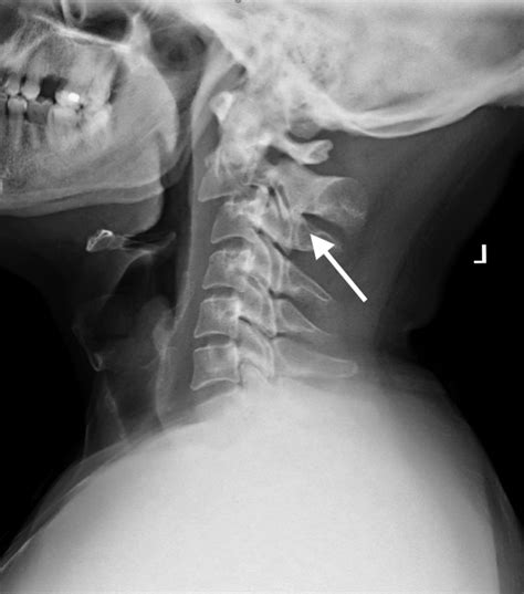 X ray of dogs cervical spine - assethat