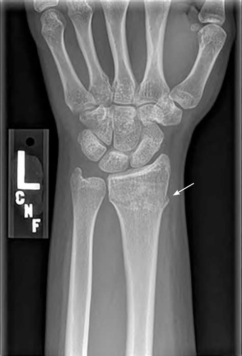 Distal Radius Bone Fracture