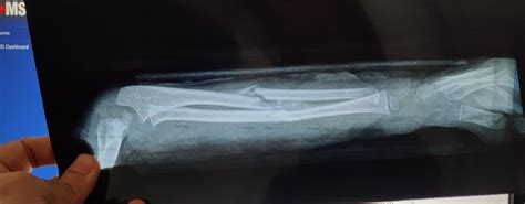 Fracture Radius+Ulna - MEDizzy