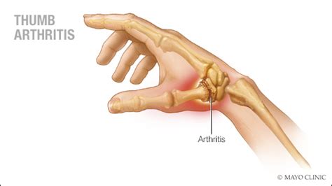 Preguntas y respuestas: Tratar la artritis del pulgar - Red de noticias ...