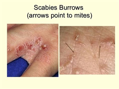 scabies bites on humans - pictures, photos