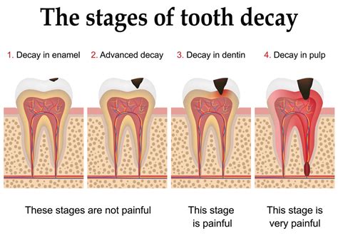 Facts About Tooth Decay | Brunelli Dental Partners