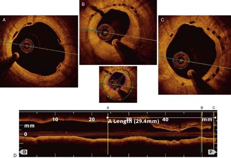 Treatment of In-Stent Restenosis | Thoracic Key