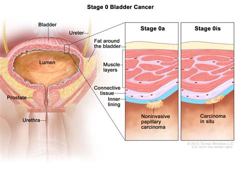 Bladder Cancer | Vanderbilt-Ingram Cancer Center