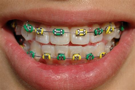 Braces Bands That Connect at Stephen Hyatt blog