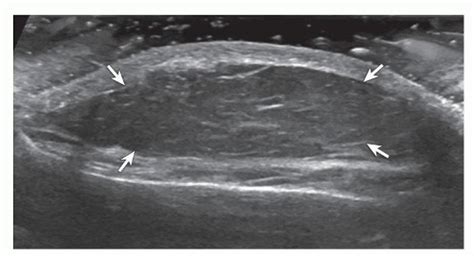 Lipoma. Ultrasound image shows oval hypoechoic subcutaneous lipoma ...