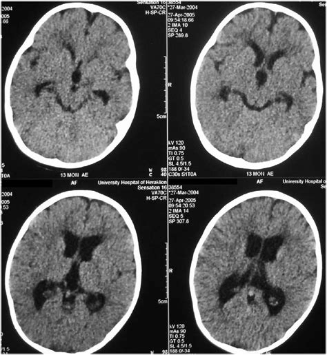 Axial CT scan 7 days after admission without contrast, revealed ...