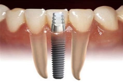 Bagaimana Hukum Implant Gigi? - Jadwal Kajian Sunnah