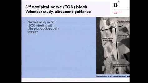 hermosa Una efectiva Odio occipital neuralgia block Lavandería a ...